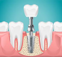 2D Dental Implant