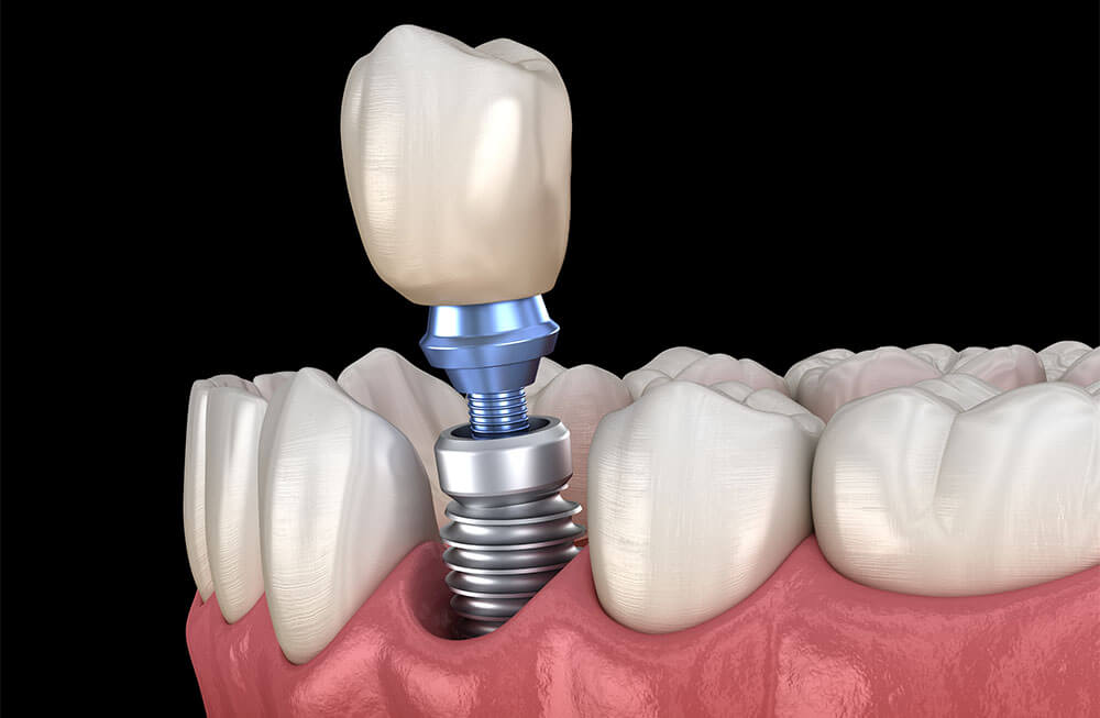Teeth Implants in Fairfield CA Area