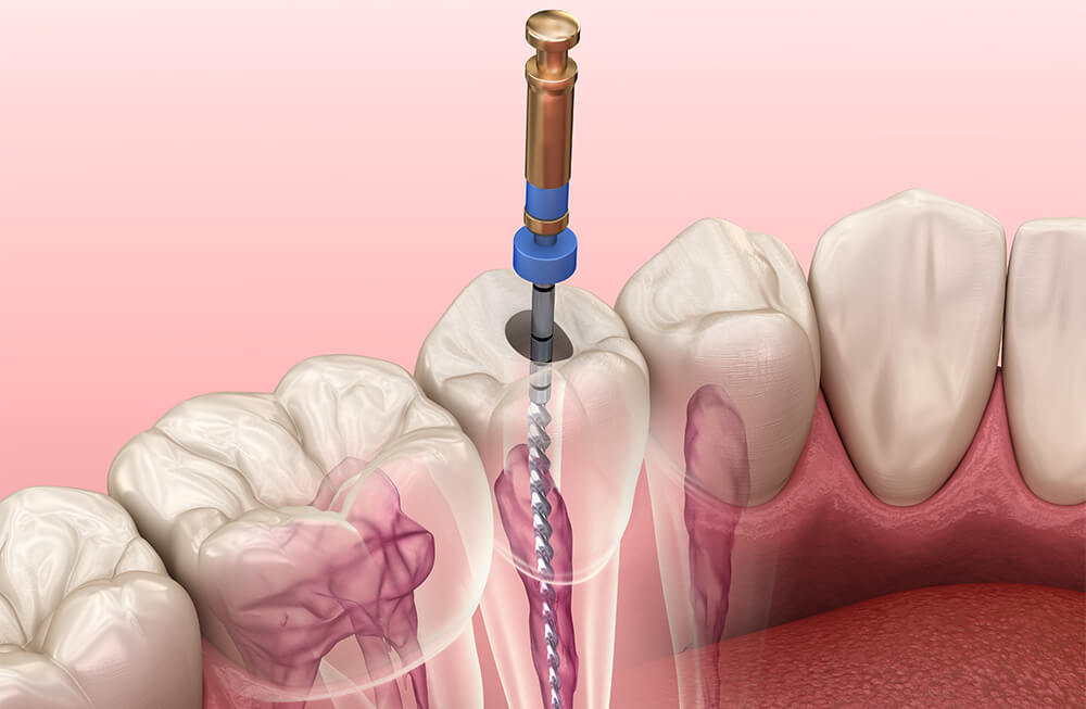 Root Canals on Front Teeth in Fairfield CA Area